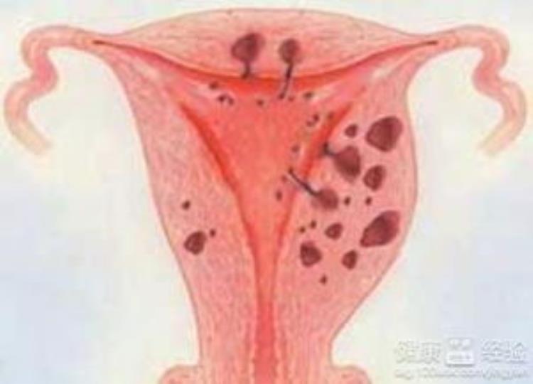 子宫肌腺症子宫的死刑,腺肌症保留子宫会癌变吗