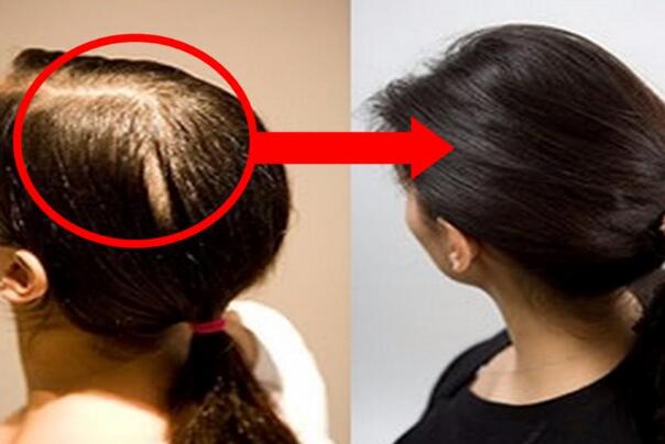 脱发是什么原因引起的-与遗传因素有关，预兆身体有疾病
